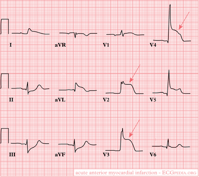 AMI acute myocardial infarction. Świerzy zawał mięśnia sercowego
