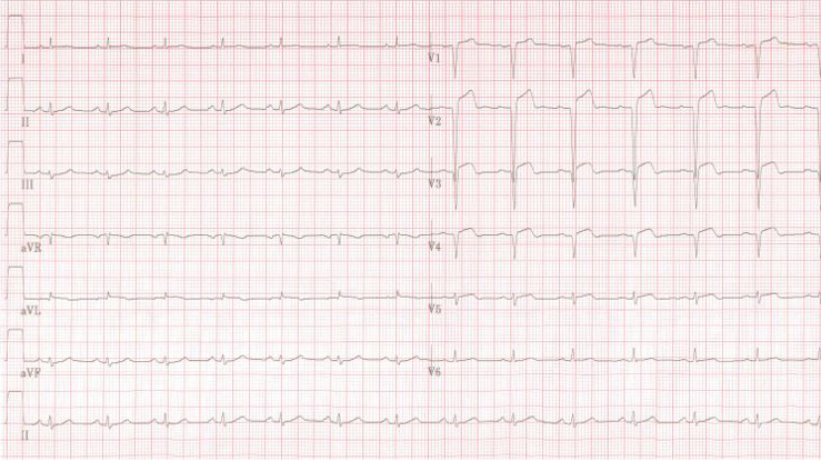 AMI anterior LAD 2days
