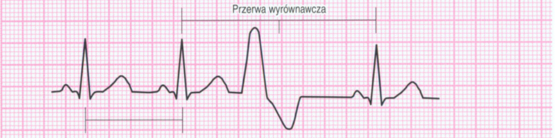 Przedwczesne pobudzenie komorowe ekg