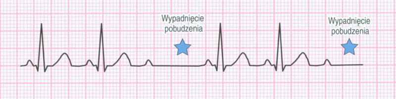 blok przedsionkowo komorowy II stopnia typu Mobitza ekg