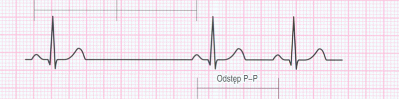 blok zatokowo przedsionkowy ekg