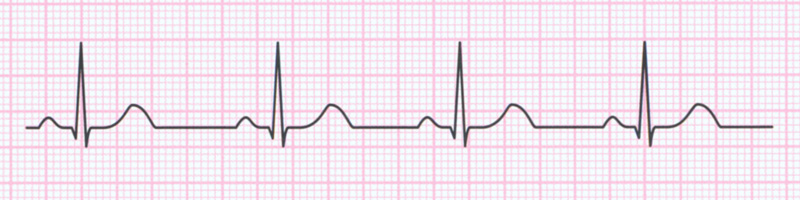 bradykardia zatokowa ekg