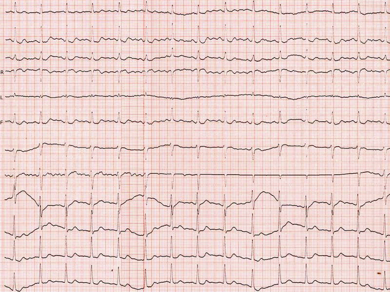 choroba wiencowa ekg
