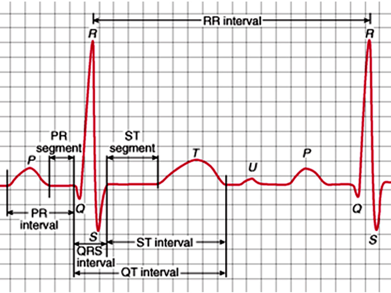 ekg zespol qrs