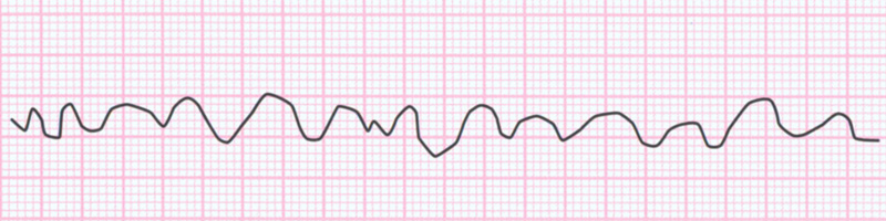 migotanie komor ekg