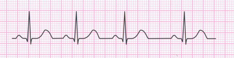 niemiarowosc zatokowa ekg