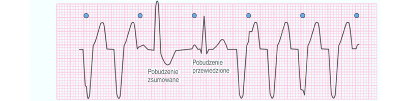 pobudzenia zsumowane i przewiedziane w VT ekg