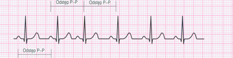 przedwczesne pobudzenie przedsionkowe ekg