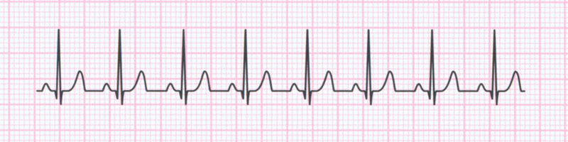 tachykardia zatokowa ekg