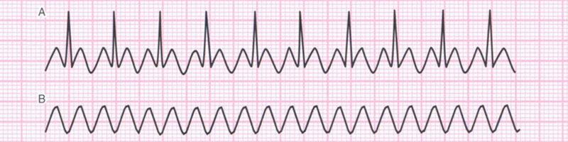 trzepotanie przesionkow ekg