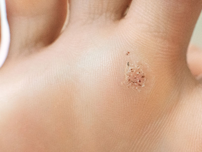 wirus hpv na stopie
