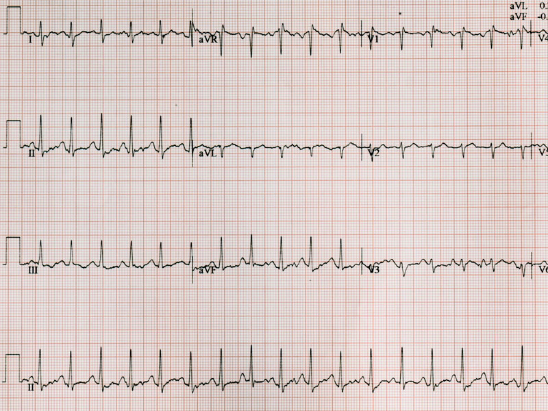zapis badania ekg