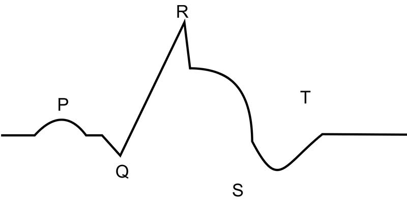 fala pardeego ekg zawal