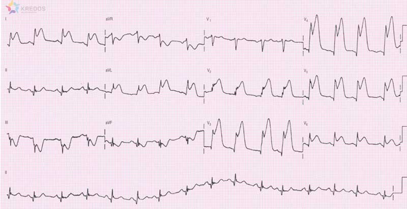 zawal przednio boczny serca zapis ekg